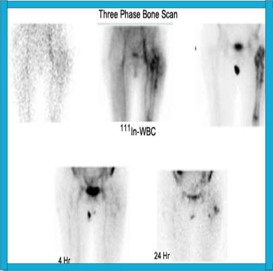 triple phase bone scan